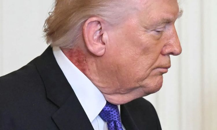 ABD Başkanı Trump'un boynunda dikkat çeken leke